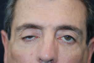 Very Brief And Simple Classification Of Ptosis